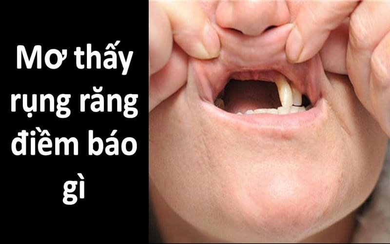 Các kiểu nằm mơ rụng răng thường gặp